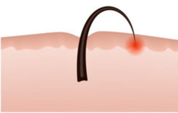 How do I  Prevent Ingrown Hairs?
